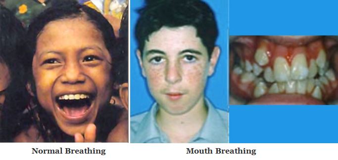 normal-vs-mouth-breathing